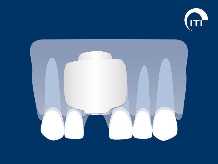 Animated smile with bone graft and two layers of membrane