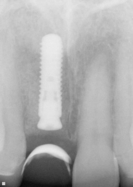 X-ray of smile with dental implant post