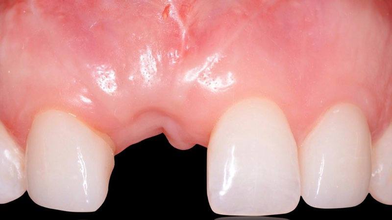 Smile with missing tooth three months after bone graft