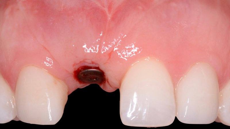 Smile after dental implant placement