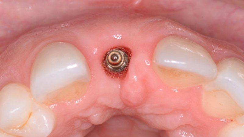 Gum tissue with dental implant post visible