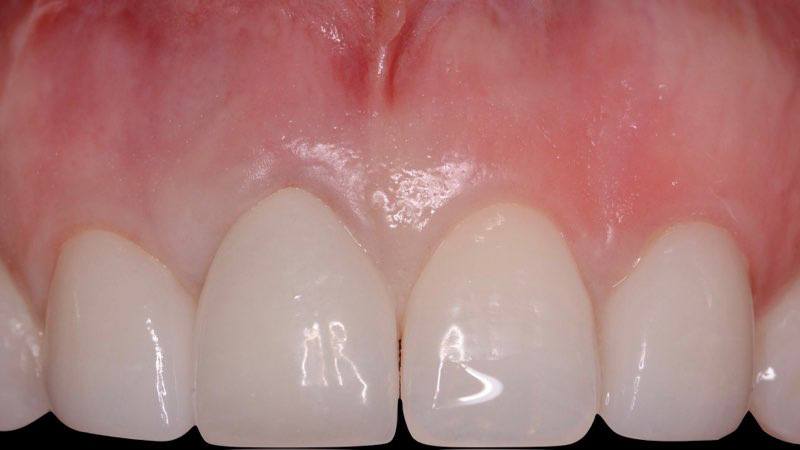 Gum tissue recession exposing tooth roots