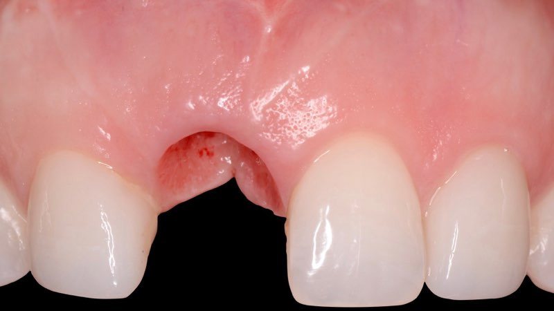 Smile after gum tissue shaping before final restoration