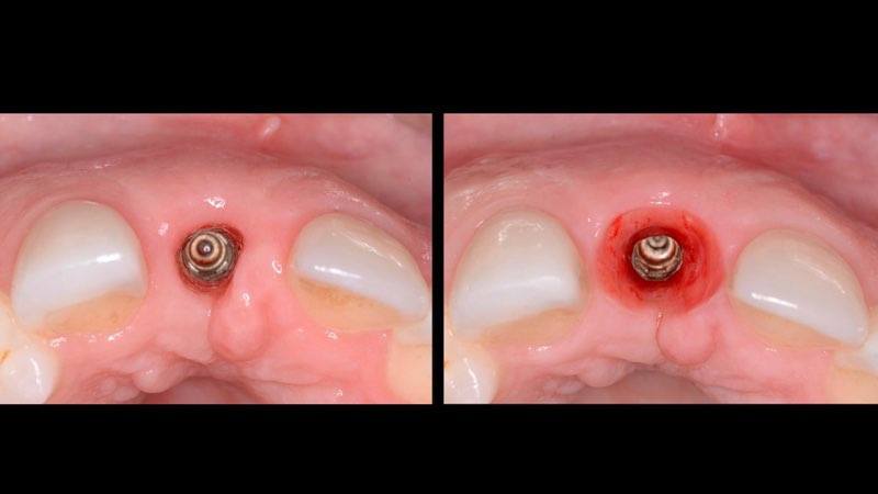 Smile before and after gum tissue reshaping