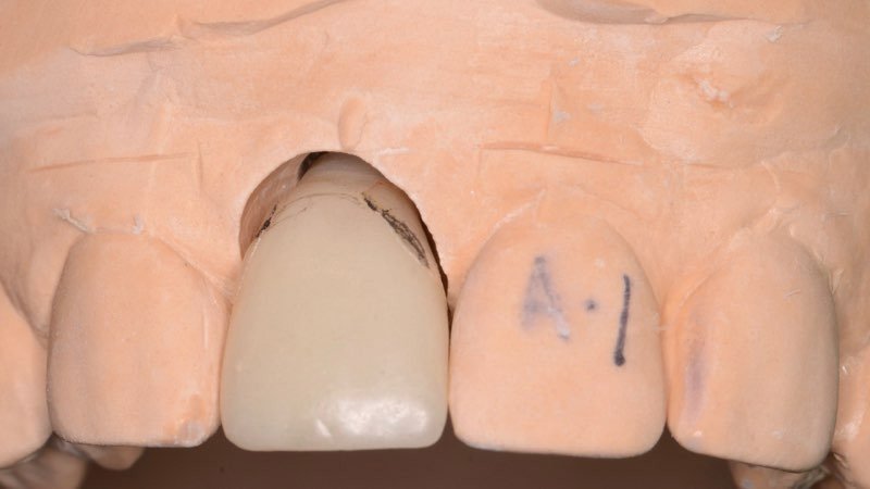 Model smile with dental crown in place