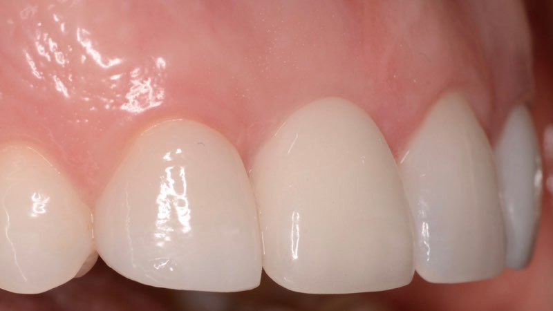 Flawless smile three years after dental implant restoration