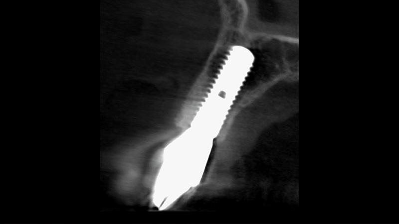 X-ray of flawless dental implant post