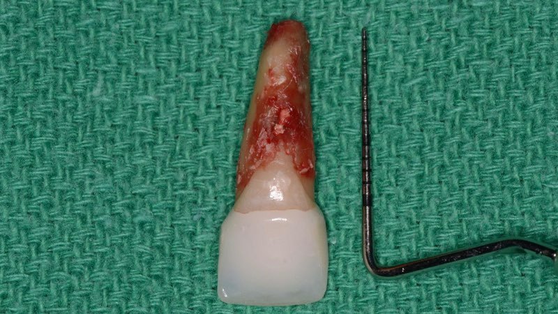 Extracted tooth