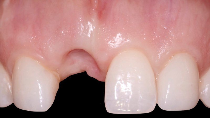 Gum tissue with missing tooth prior to replacement