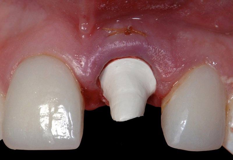 Smile with dental implant and temporary abutment in place