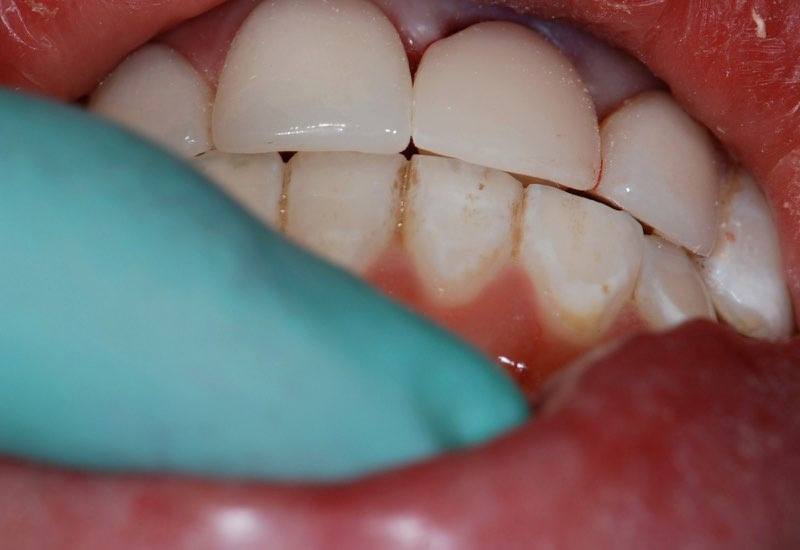 Bite examination after temporary crown placement