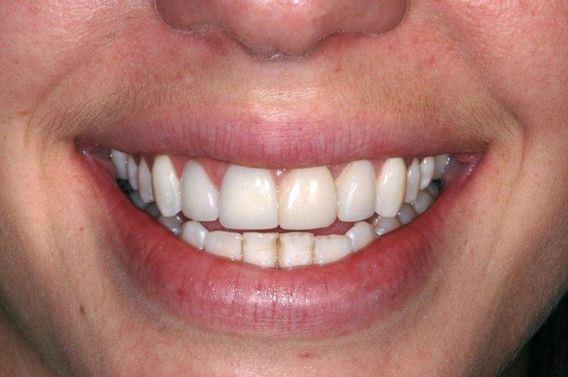Full smile two months after dental implant placement