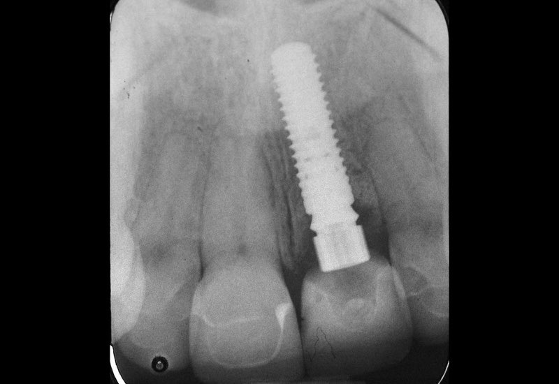 X-ray of smile five months after dental implant placement