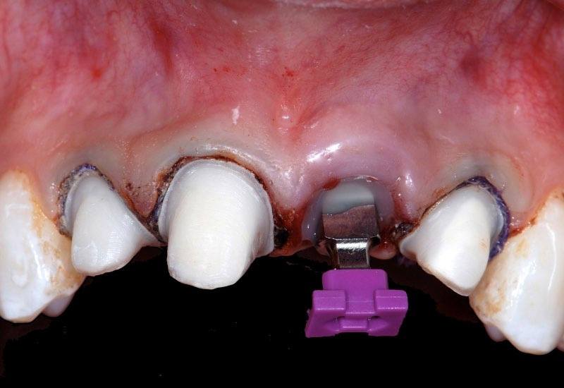 Dental implant post with impression cap