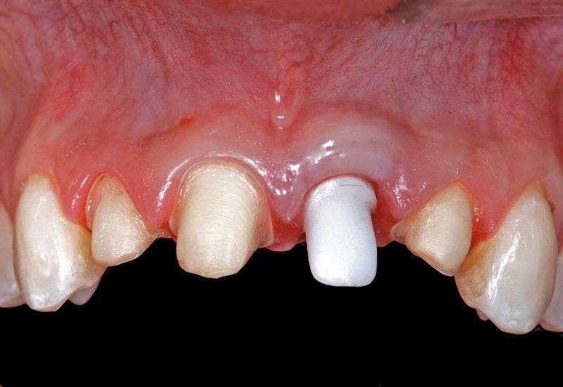 Ceramic abutment visible over dental implant post