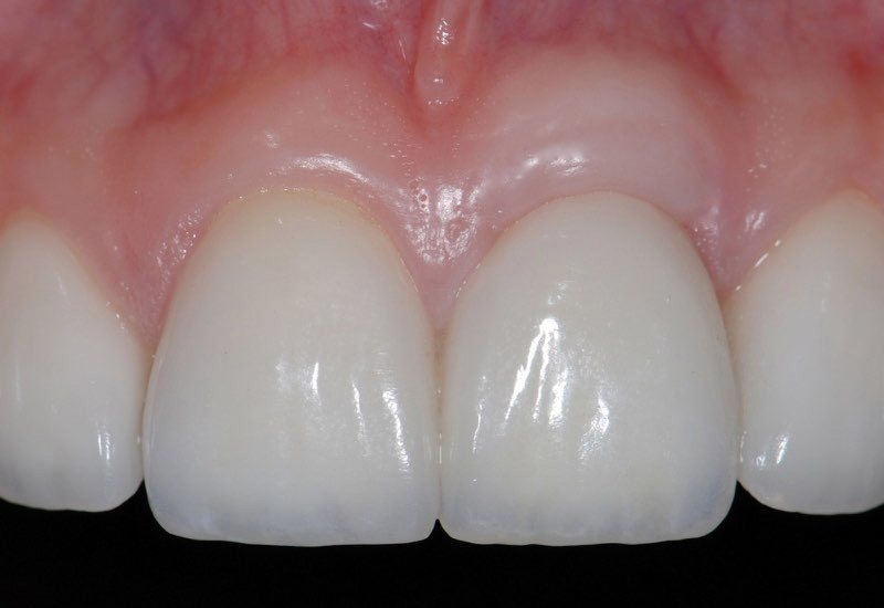 Final result with full healthy smile