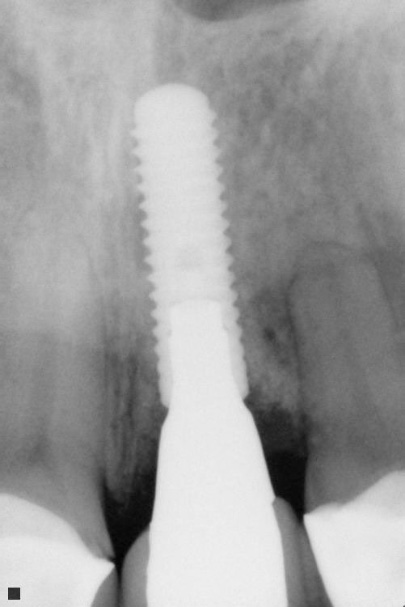 X-ray of dental implant supported replacement tooth