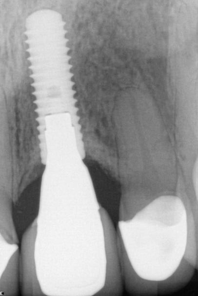 X-ray of repaired smile