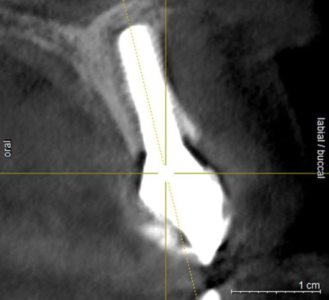 3 D C B C T scan seven years after tooth replacement