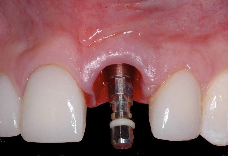 Smile with dental implant post visible in gum tissue