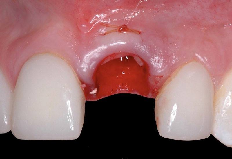 Gum tissue after graft is placed
