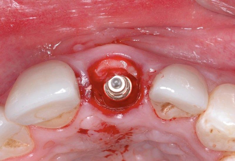 Gum tissue with dental implant post visible