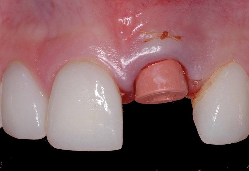Smile with healing cap placed over dental implant post