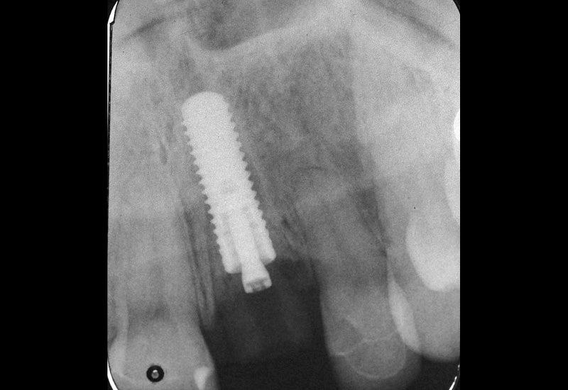 X-ray of smile with dental implant in place