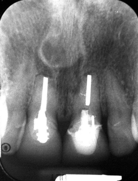 Initial x-ray of damaged teeth