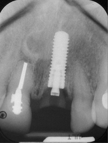 X-ray of dental implant post in position