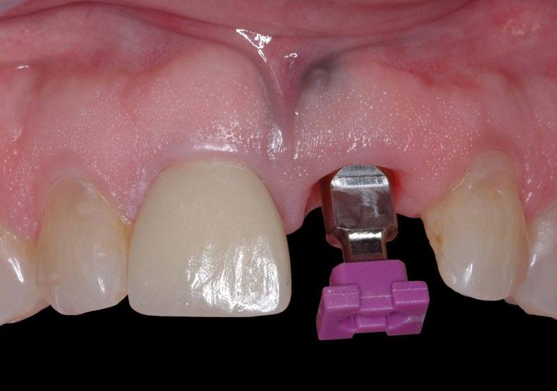 Dental impression cap over dental implant post