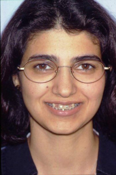 Young woman with congenitally missing teeth