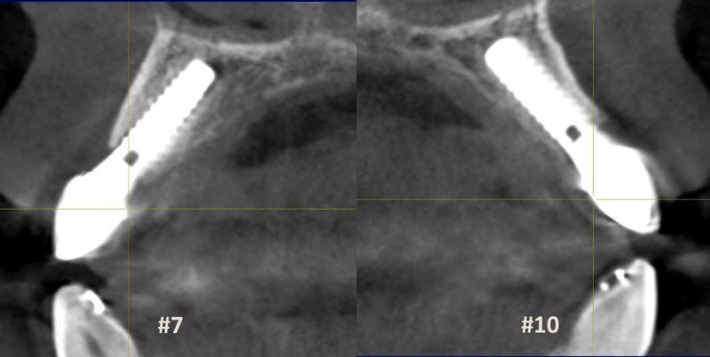 C B C T scan of smile 14 years after restoration