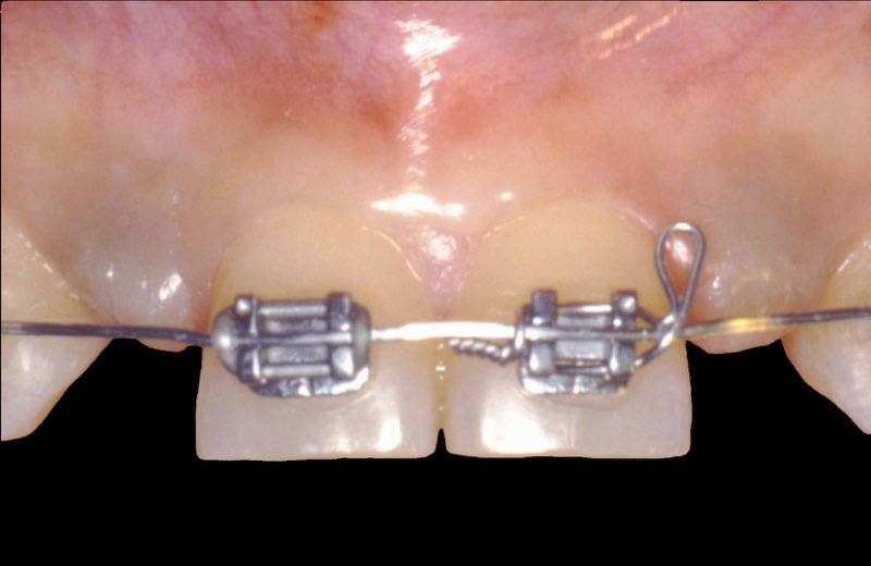 Patient with missing teeth and braces