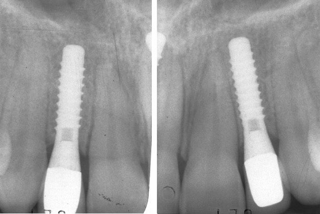 X-ray of smile after tooth replacement