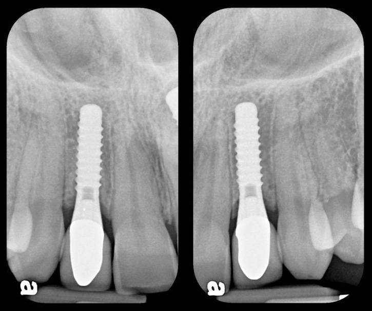 X-rays of flawlessly functioning dental implants 14 years after treatment