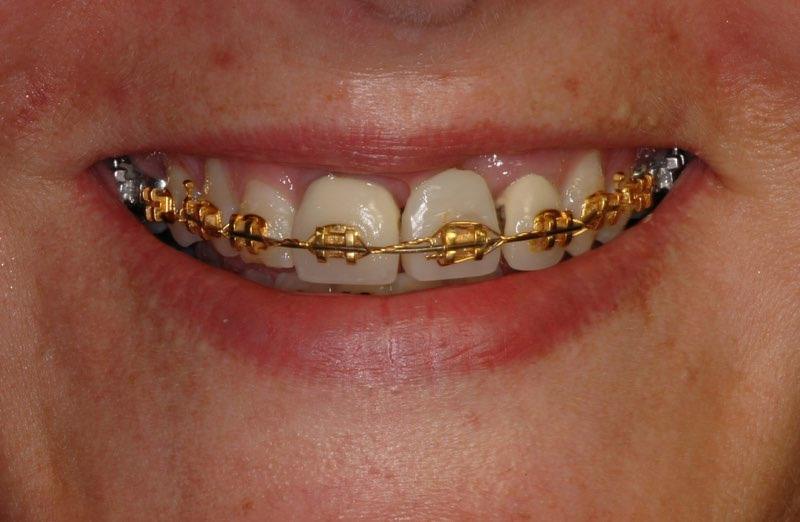 Closeup of smile with braces