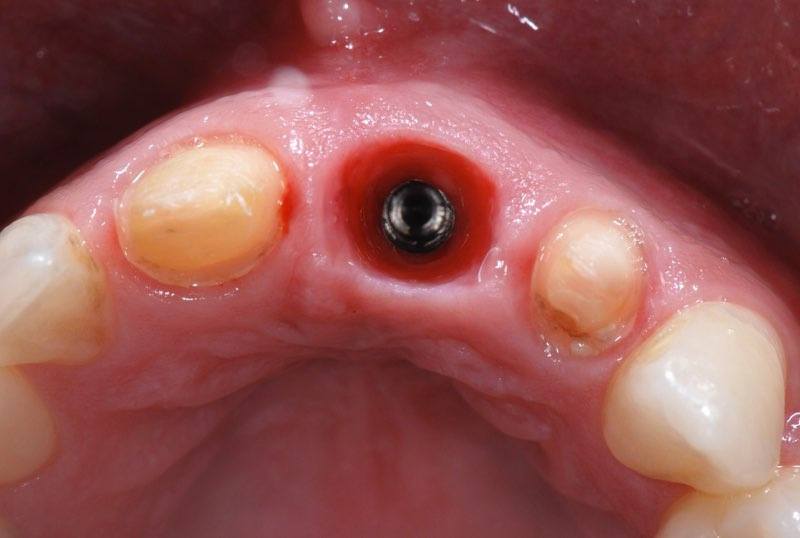 Dental implant post in place with gum tissue shaping