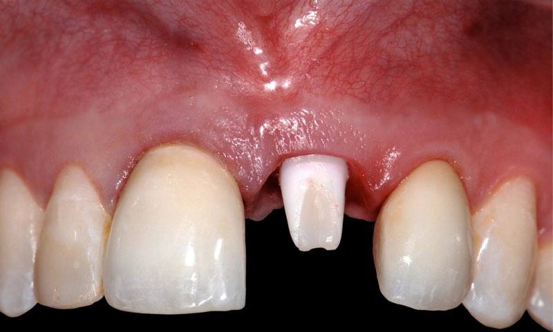 Zirconium abutment visible within the gum line