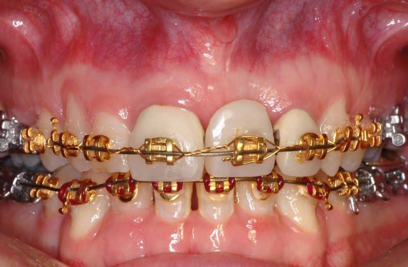 Smile with braces and damaged teeth