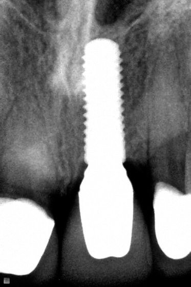 X-ray of smile after dental restoration