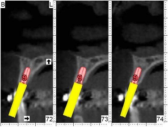 C T scan showing positioning for dental implant posts