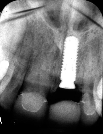 X-ray of dental implant after placement