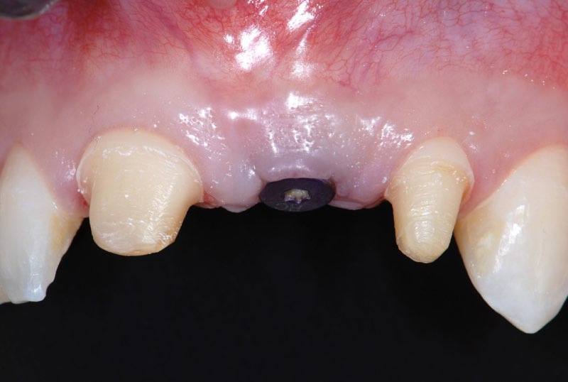 Prepared smile two months after dental implant post placement