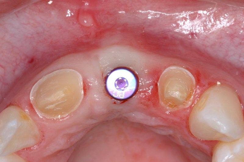 Dental implant post visible in gum tissue