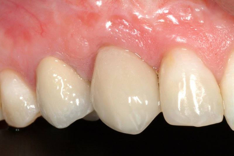 Damaged smile before treatment