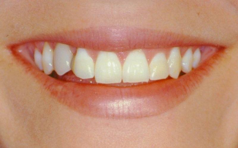 Smile with damaged teeth