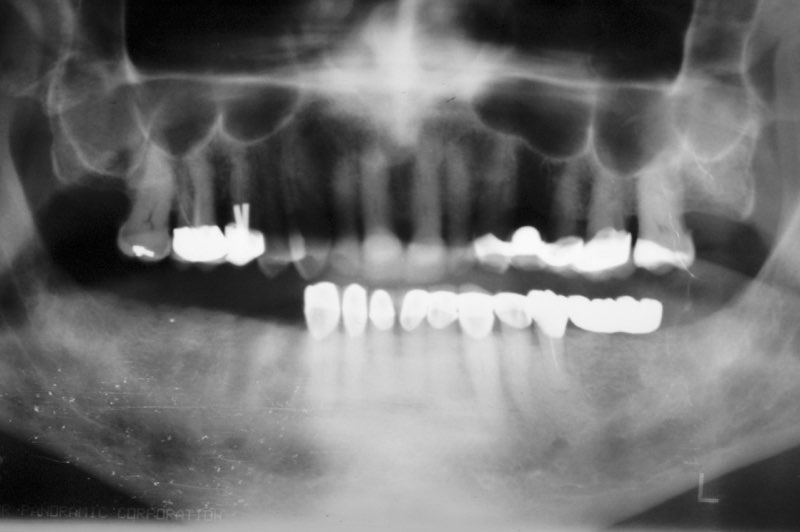 X-ray of smile with several missing teeth from the bottom row