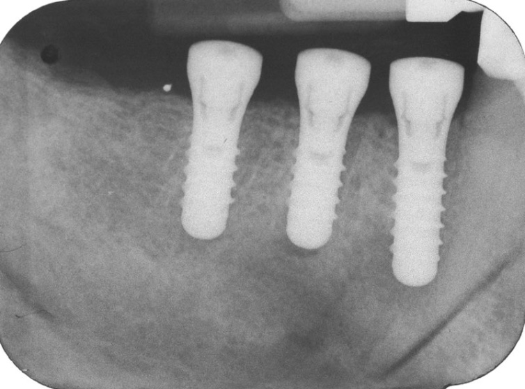 X-ray of three implant posts positioned along the jawbone