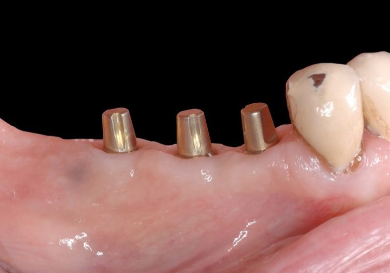Gum line with three abutments in place